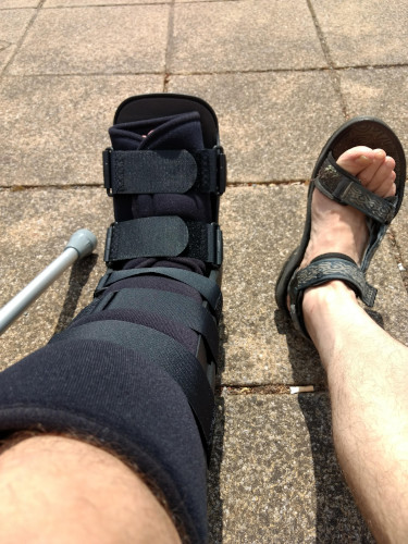 Broken ankle image